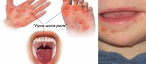 Профілактика ентеровірусної інфекції